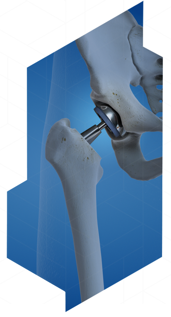 Anterior Hip Replacement Minimally Invasive NYC Jeffrey A. Geller, MD