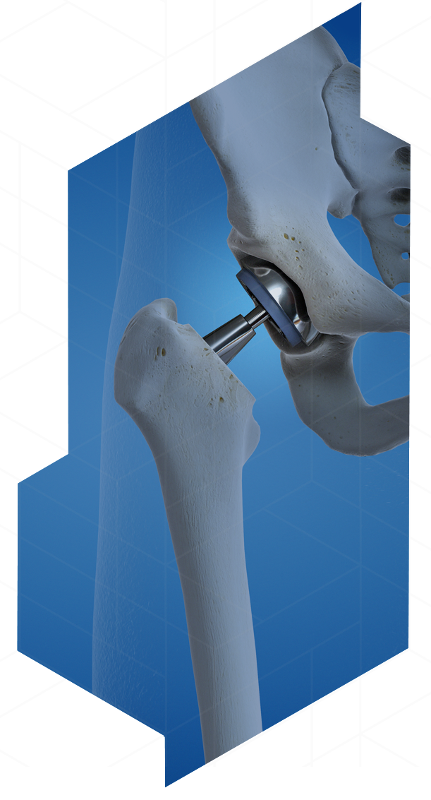 Anterior Hip Replacement Minimally Invasive Nyc Jeffrey A Geller Md