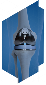 Partial Knee Replacement Surgery