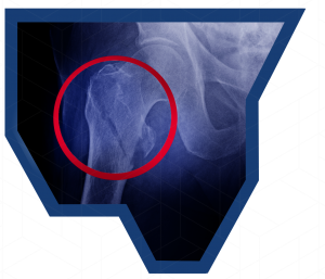 Hip Fracture Fixation - diagnosis xray